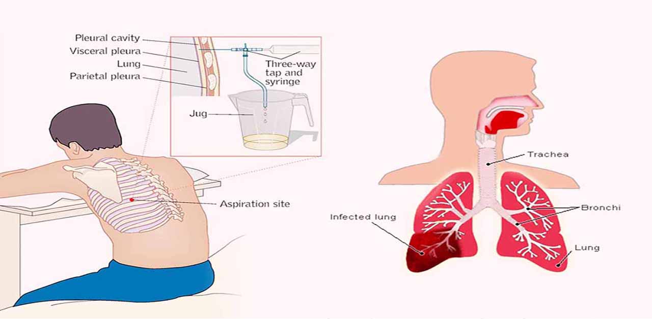 Tràn dịch màng phổi là gì? Bệnh này có nguy hiểm không?