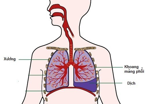 Tràn dịch màng phổi nguy hiểm không?