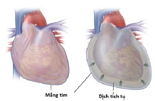 Tràn dịch màng tim có nguy hiểm không?