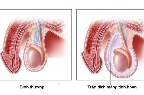 Tràn dịch màng tinh hoàn ở người lớn