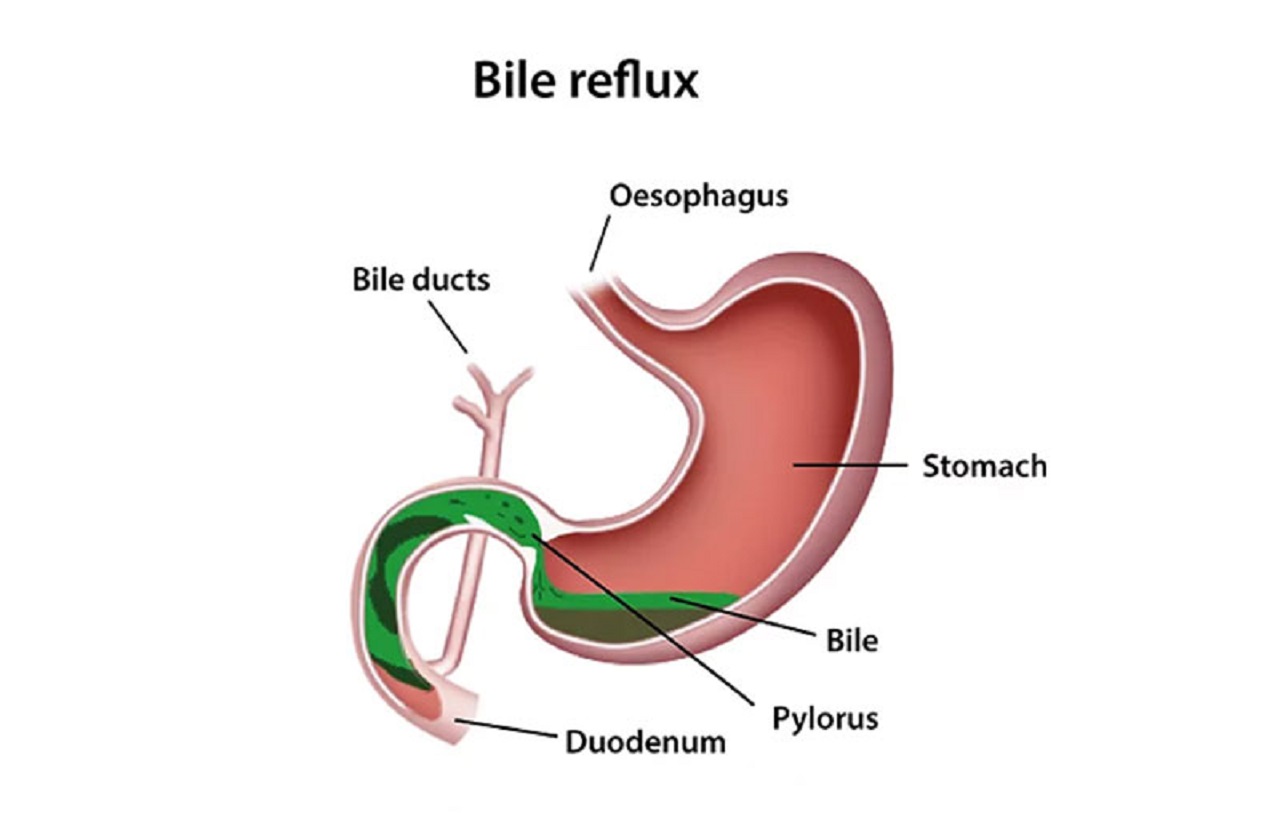 Trào dịch mật – Nguyên nhân và cách điều trị