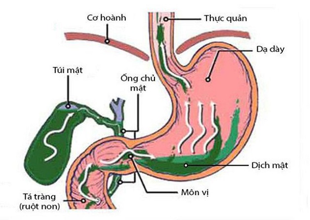 Trào dịch mật – Nguyên nhân và cách điều trị