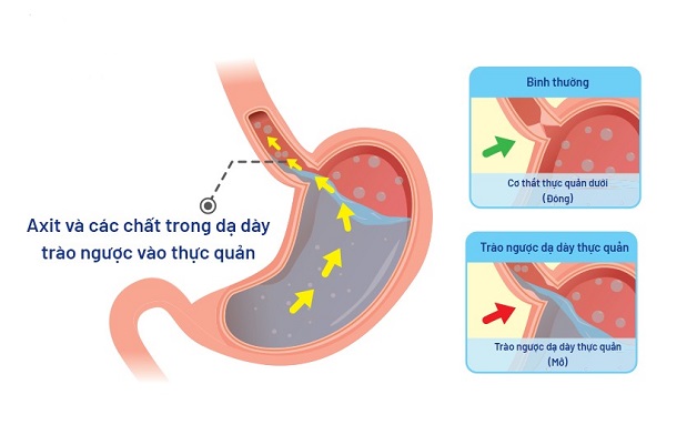 Trào ngược dạ dày có gây đau đầu không?