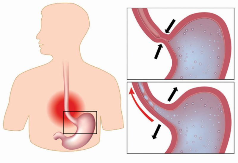 Trào ngược dạ dày có trị hết không: Giải đáp – Hướng dẫn điều trị