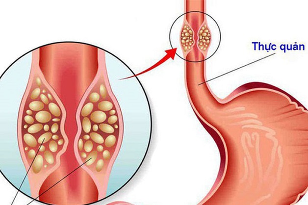 Trào ngược dạ dày độ b: nguyên nhân, triệu chứng và cách điều trị