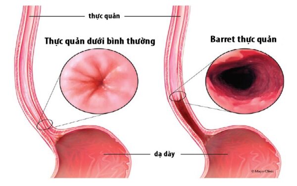 Trào ngược dạ dày lâu năm nguy hiểm hơn bạn nghĩ