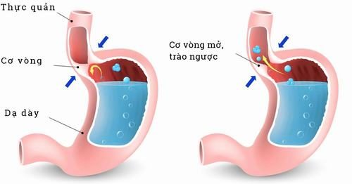 Trào ngược dạ dày thực quản có chữa được không?