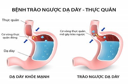 Trào ngược dạ dày thực quản gây viêm họng