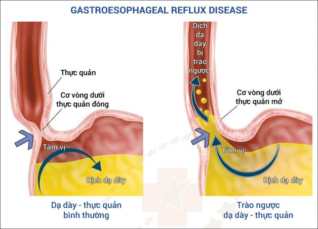 Trào ngược dạ dày thực quản: Nhận biết và cách chữa trị