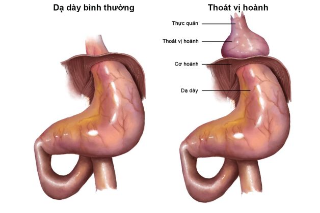 Trào ngược dạ dày thực quản: Nhận biết và cách chữa trị