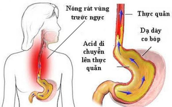 Trào ngược dạ dày thực quản và các biến chứng nguy hiểm