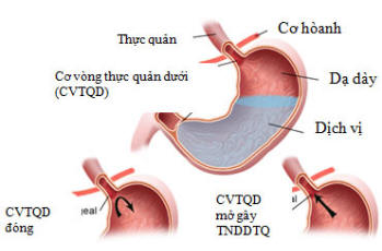 Trào ngược dạ dày – thực quản