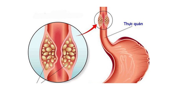 Trào ngược dạ dày về đêm: mức độ nguy hiểm và cách chữa trị