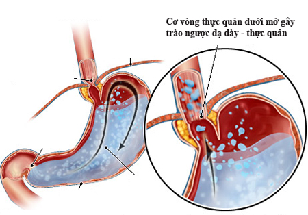 Trào ngược dịch dạ dày