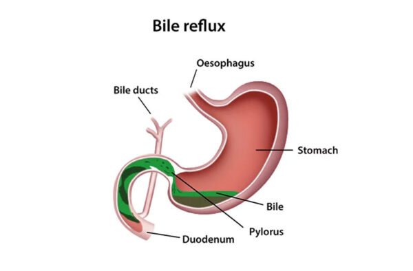 Trào ngược dịch mật dạ dày: Nguyên nhân, triệu chứng và điều trị