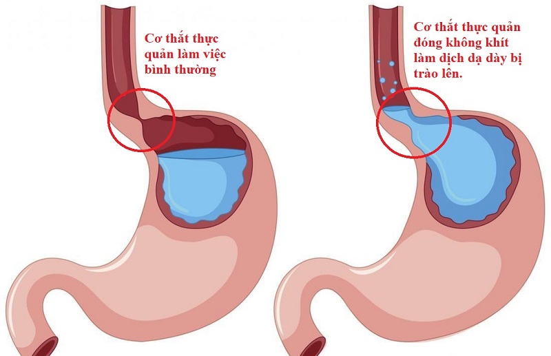 Trào ngược nuốt vướng – “Chỉ điểm” bệnh lý cần cẩn trọng