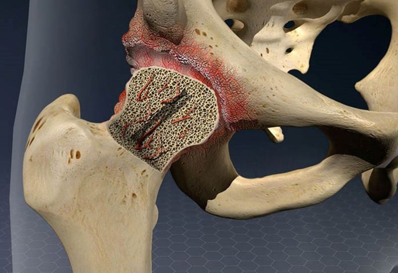 Trật khớp háng: Hậu quả khôn lường nếu không điều trị kịp thời