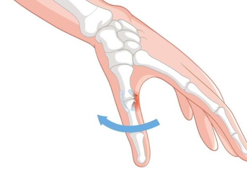 Trật khớp ngón tay cần khám ngay kẻo để lại nhiều di chứng