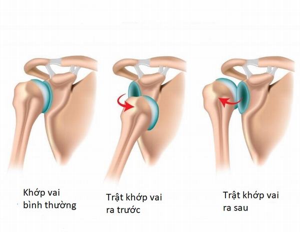 Trật khớp vai có nguy hiểm không và cách xử trí hiệu quả?