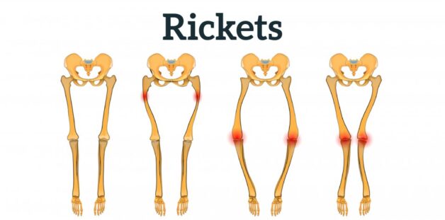 Trẻ bị còi xương và những điều bố mẹ phải làm