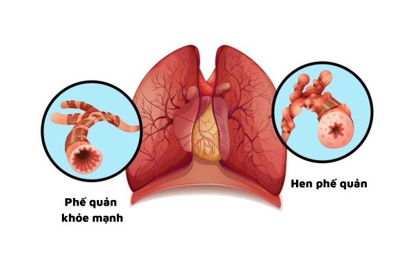 Trẻ bị hen phế quản và những điều cha mẹ cần biết