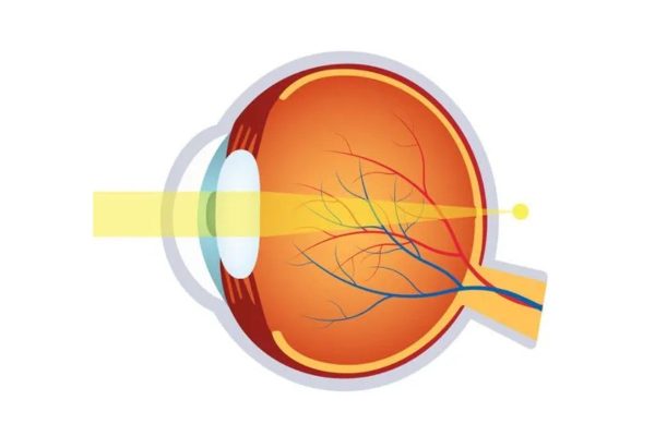 Trẻ bị tật khúc xạ mắt có nguy hiểm không?