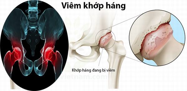 Trẻ bị viêm khớp háng và 4 cách điều trị hiệu quả