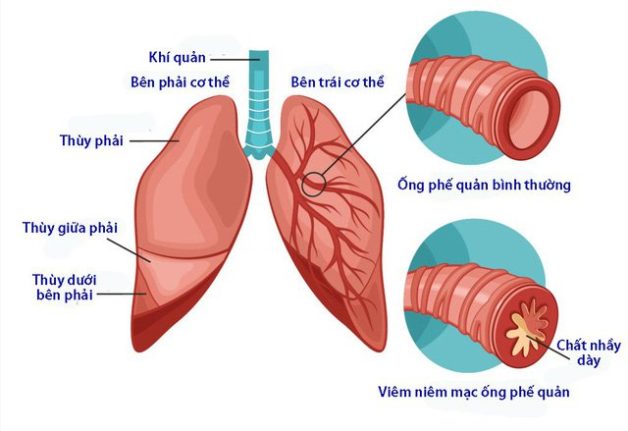 Trẻ bị viêm phế quản nguy cơ suy hô hấp rình rập