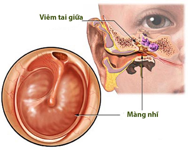 Trẻ bị viêm tai giữa kiêng ăn gì và nên ăn gì?