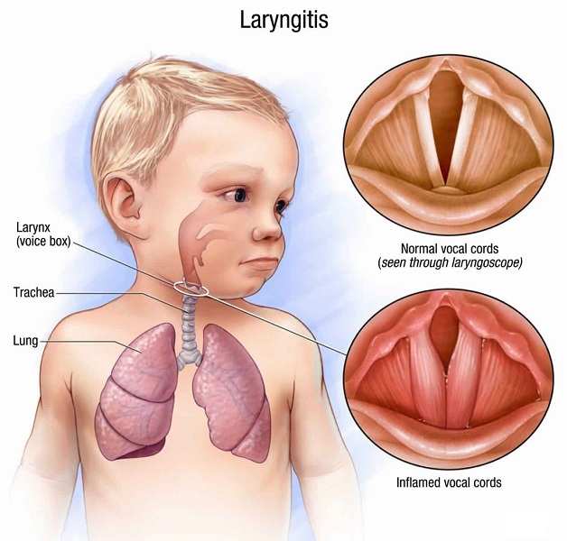 Trẻ bị viêm thanh quản: Cách điều trị và chăm sóc trẻ tại nhà