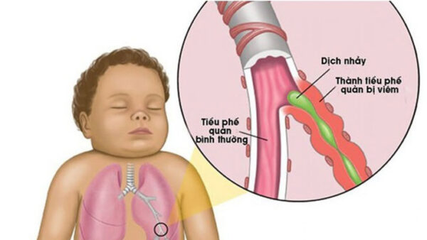 Trẻ bị viêm tiểu phế quản: cách điều trị hiệu quả