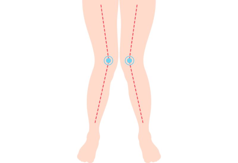 Trẻ còi xương: Những nguyên tắc điều trị cốt lõi