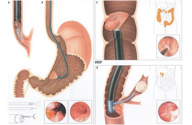 Trẻ em bị viêm dạ dày hp có nguy hiểm không ?