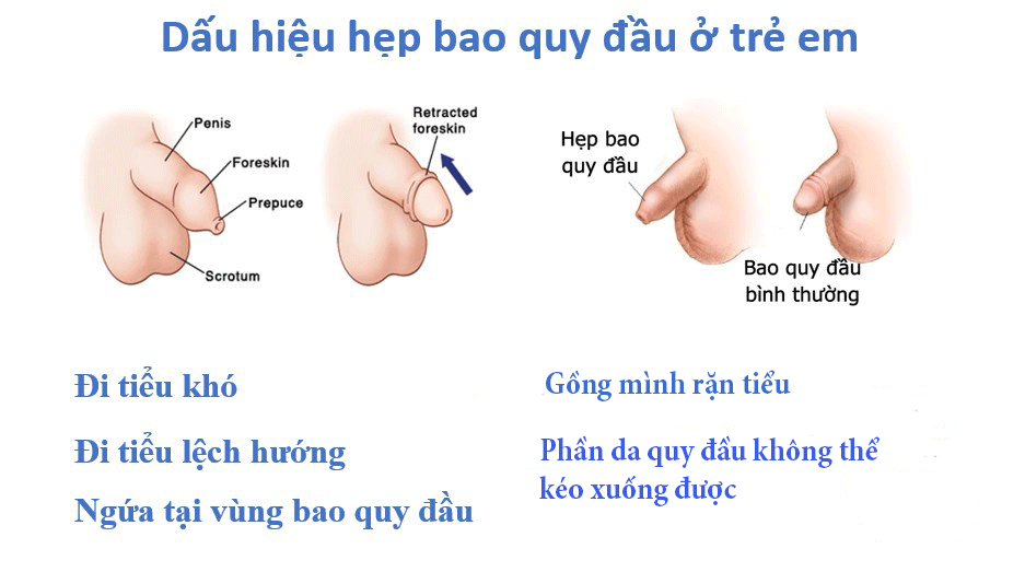 Trẻ nhỏ bị hẹp bao quy đầu khi nào cần cắt bỏ?