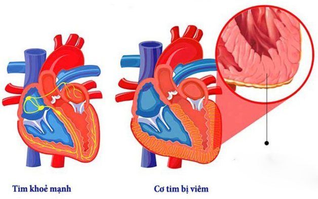 Trẻ nhỏ bị sốt siêu vi có nguy hiểm không?