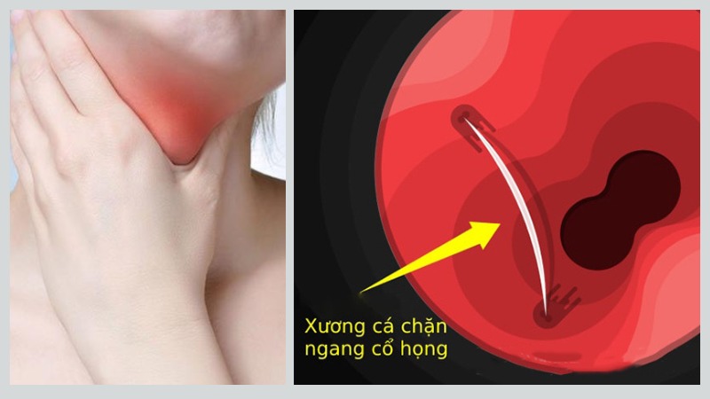 Trị hóc xương cá nhỏ: Xử lý đúng cách để tránh nguy hiểm