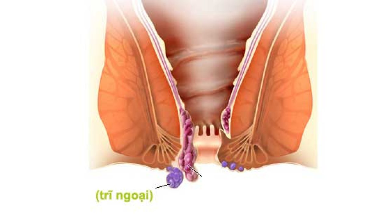 Trĩ ngoại chữa như thế nào – Góc giải đáp