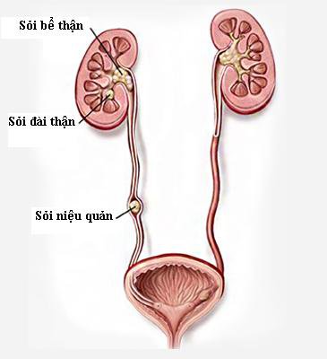 Trị sỏi niệu quản bằng công nghệ cao không đau, không mổ