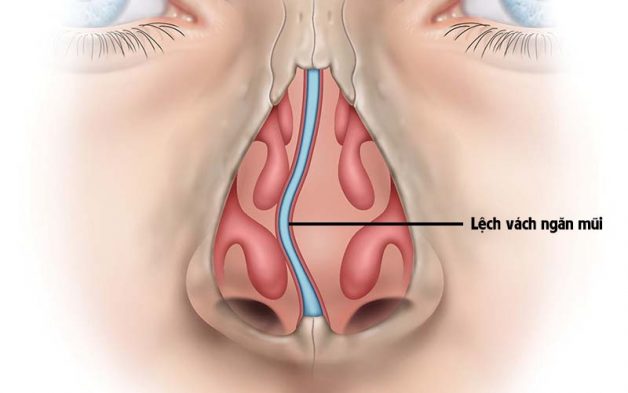 Trị viêm xoang trán theo đúng nguyên nhân bệnh