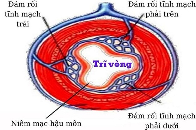 Trĩ vòng là gì? Tìm hiểu phương pháp cắt trĩ vòng hiệu quả