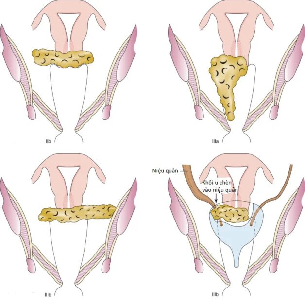 Triển vọng của bệnh ung thư cổ tử cung giai đoạn 3