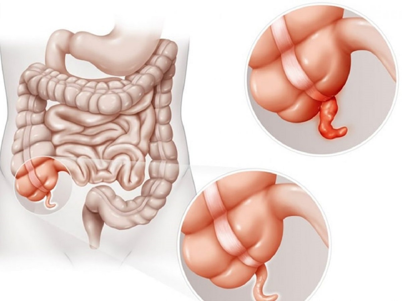 Triệu chứng bệnh đau ruột thừa không thể bỏ qua