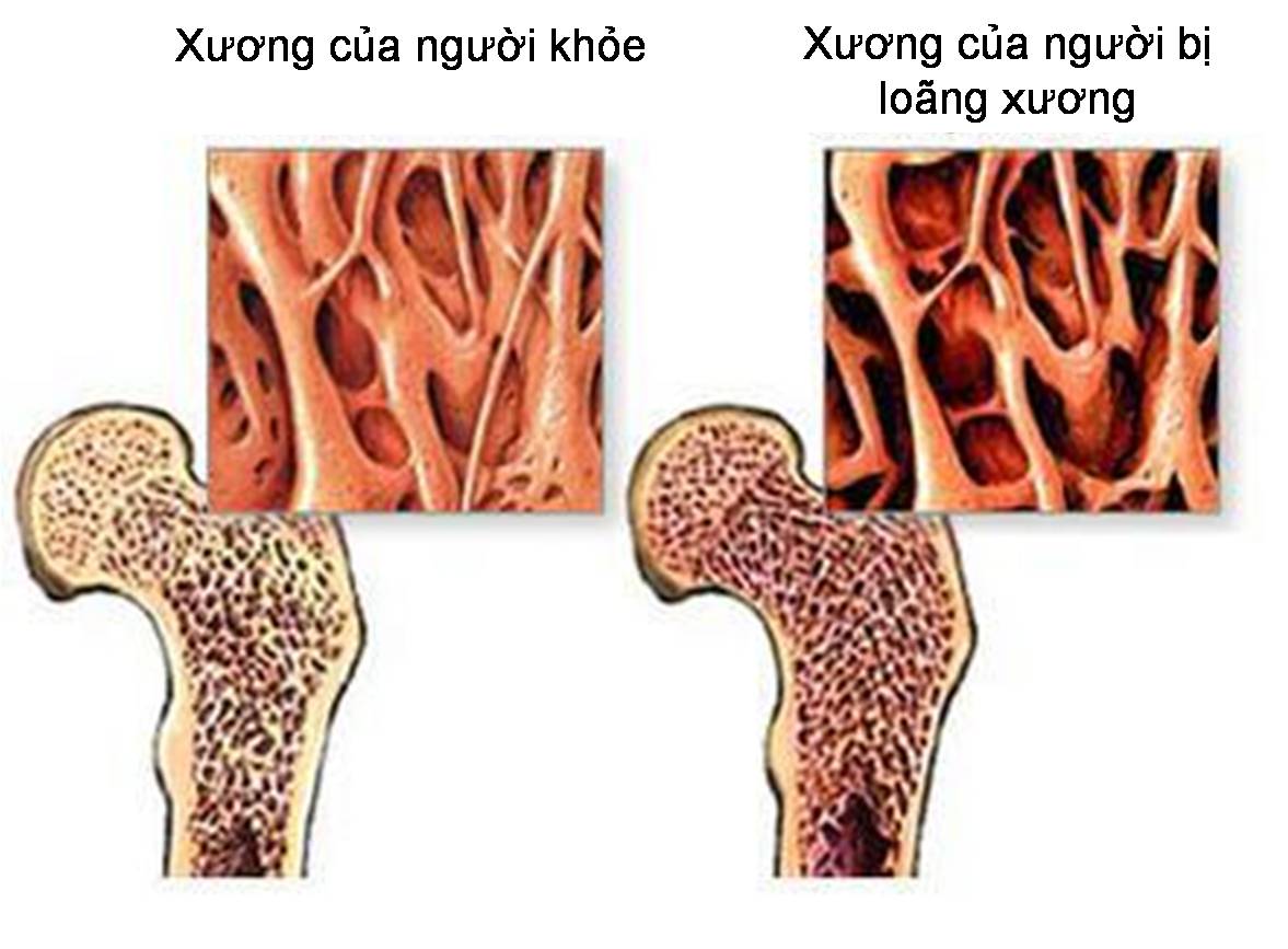 Triệu chứng bệnh loãng xương có xu hướng tăng nhanh