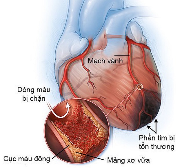 Triệu chứng bệnh mạch vành tim có dễ nhận biết không?