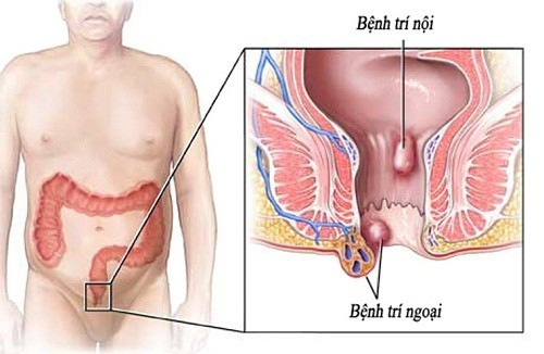 Triệu chứng bệnh trĩ có xu hướng tăng nhanh