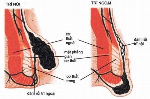 Triệu chứng bệnh trĩ thường gặp