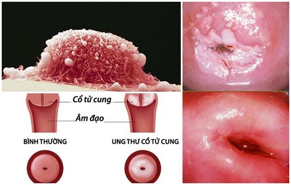 Triệu chứng bệnh ung thư cổ tử cung giai đoạn III