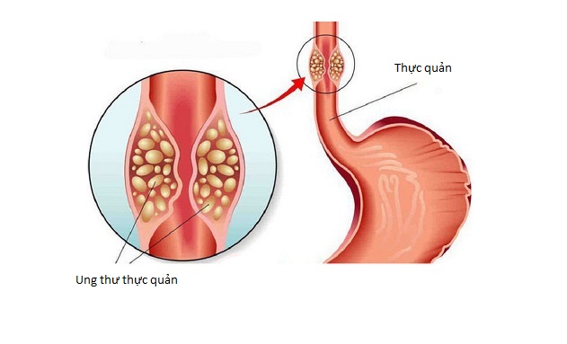 Triệu chứng bệnh ung thư thực quản phổ biến