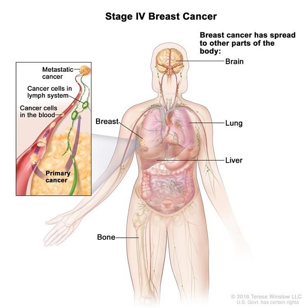 Triệu chứng bệnh ung thư vú di căn