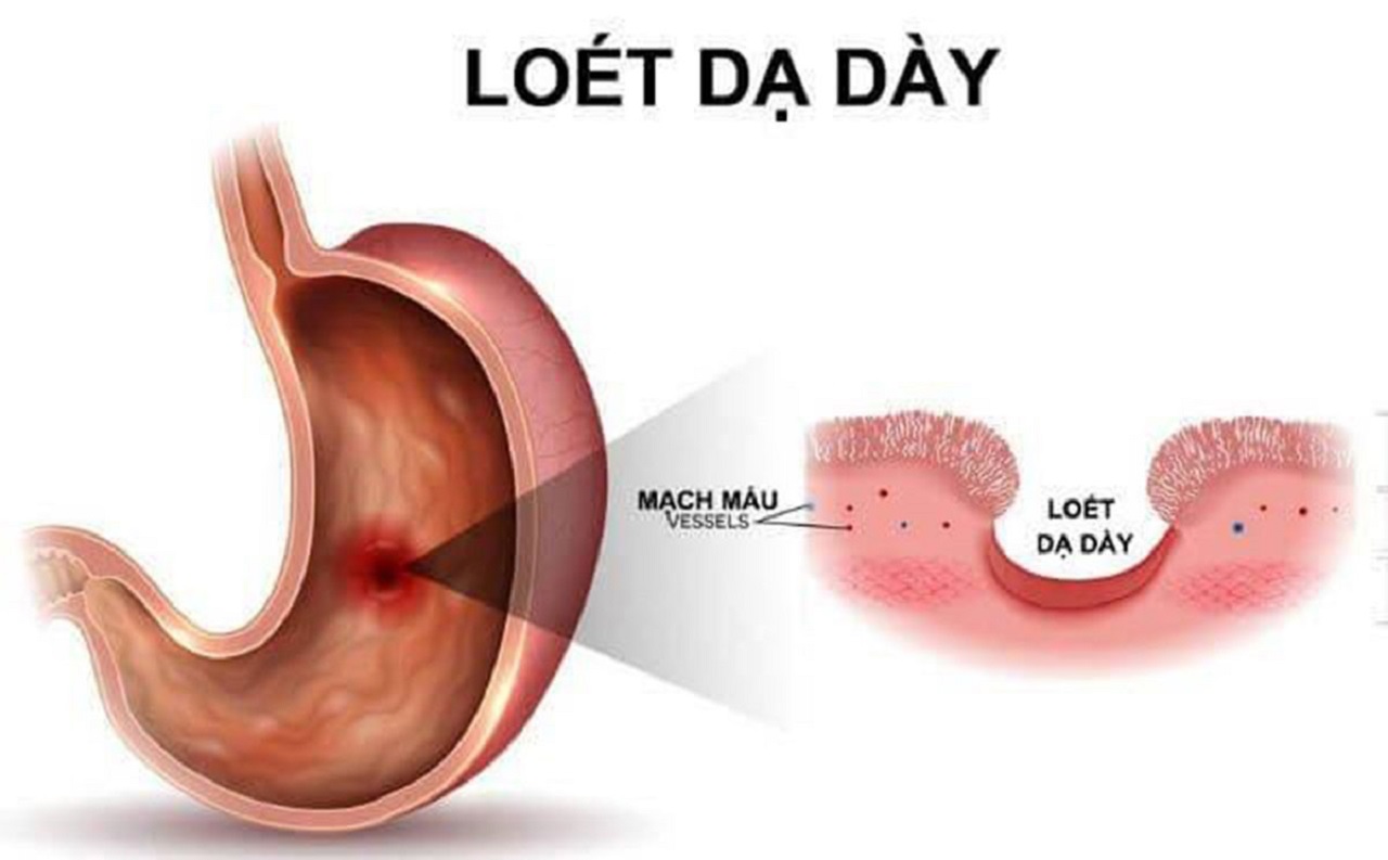 Triệu chứng bệnh viêm loét dạ dày phổ biến